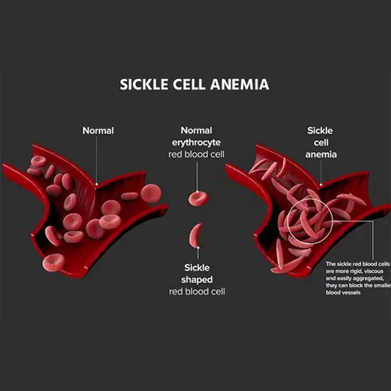 Sickle Cell Anemia Mutation